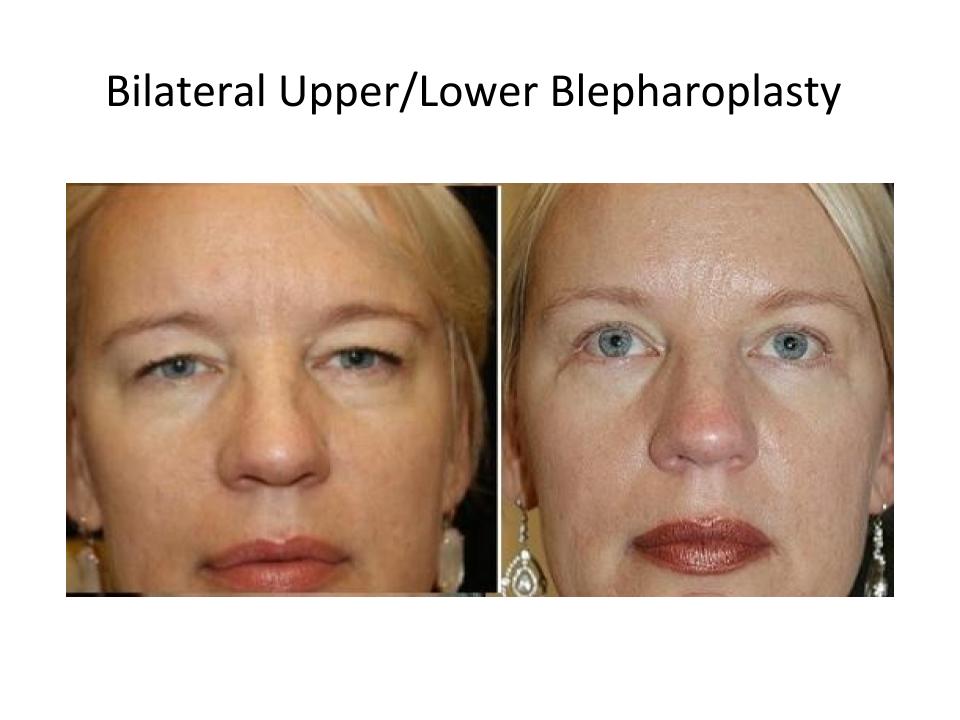 Patient before and after a upper and lower blepharoplasty in Austin from Dr. Amato