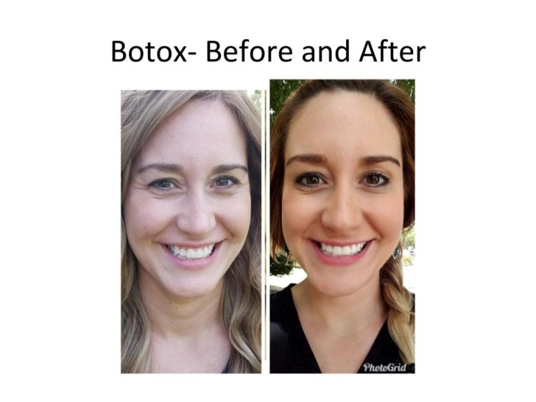 Dr. Malena Amaot's Austin. TX Botox results on a patient in her 20s