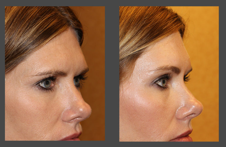 Before and after photo gallery of an endoscopic brow lift in Austin from Dr. Amato