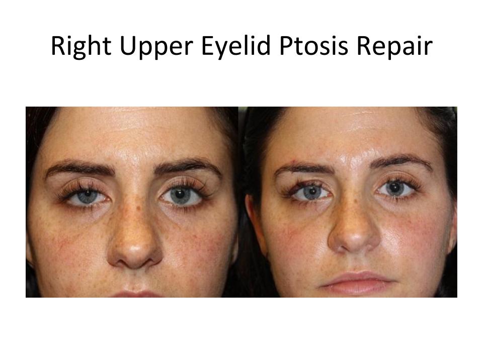 Patient treated by Dr. Amato for upper eyelid ptosis