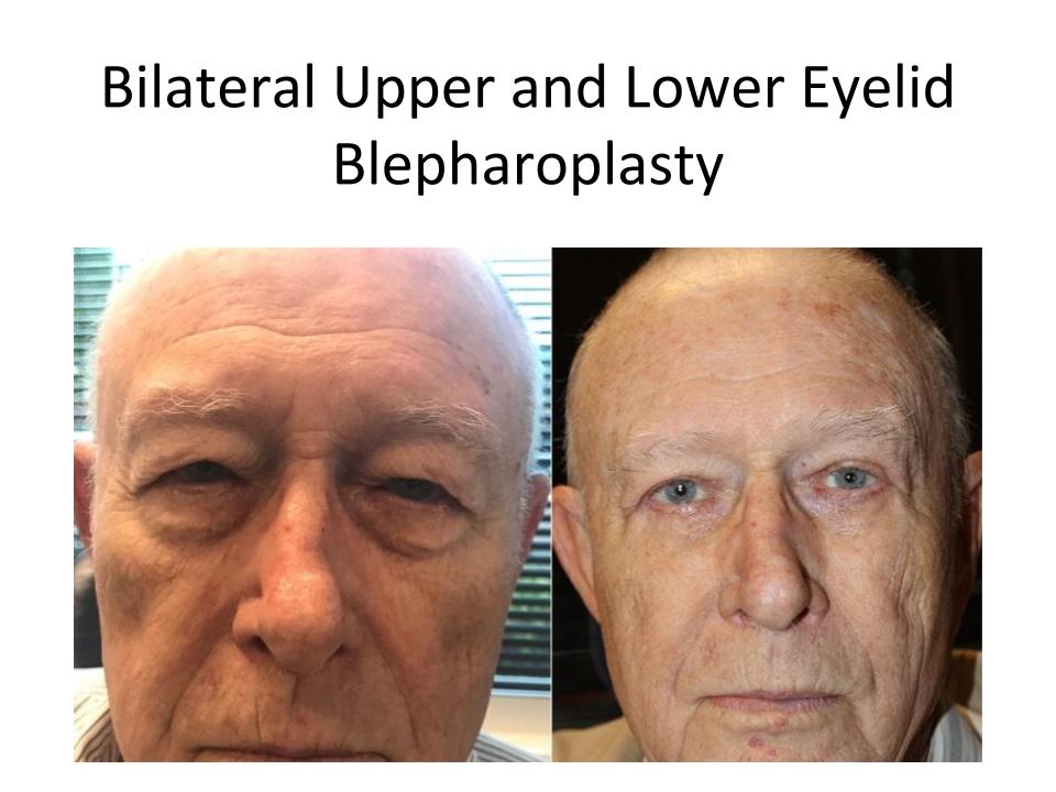 Male patient pictured before and after his Austin eyelid lift surgery with Dr. Amato