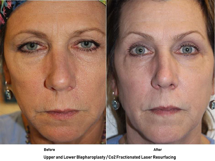 Patient results from and eye lift and laser skin resurfacing in Austin with Dr. Malena Amato