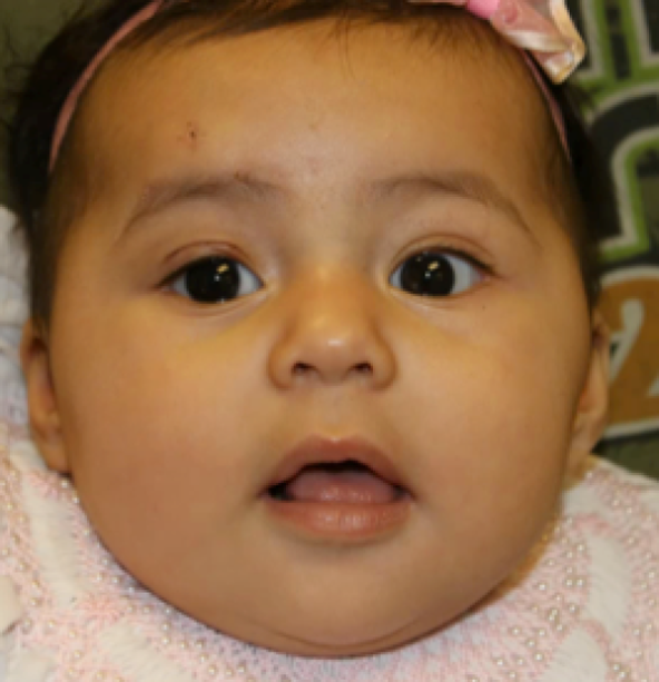 congenital ptosis after